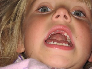 De tweede voortand is eruit